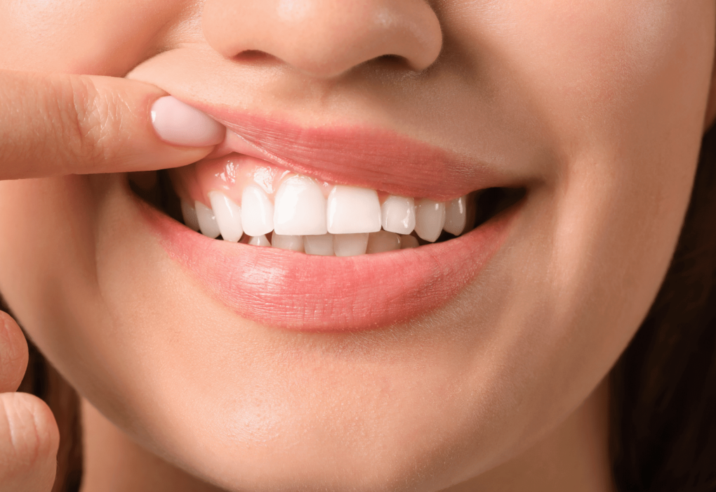 Preventive Measures For Optimal Gum Line Health