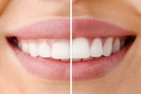 Laser Therapy For Healing Gums: A Modern Approach