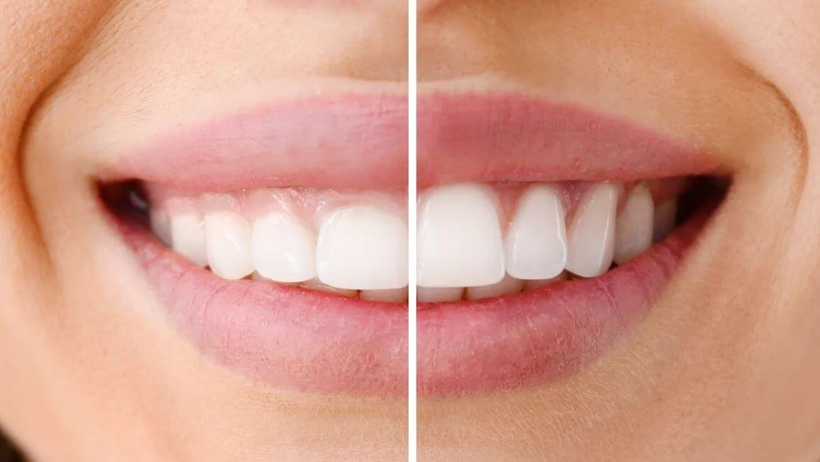 Laser Therapy For Healing Gums: A Modern Approach