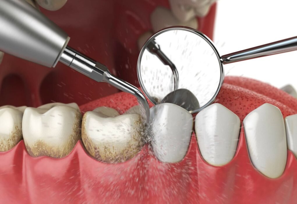 Periodontal Maintenance Vs Cleaning