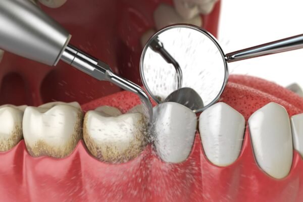 Periodontal Maintenance Vs Cleaning Periodontal Maintenance Vs Cleaning
