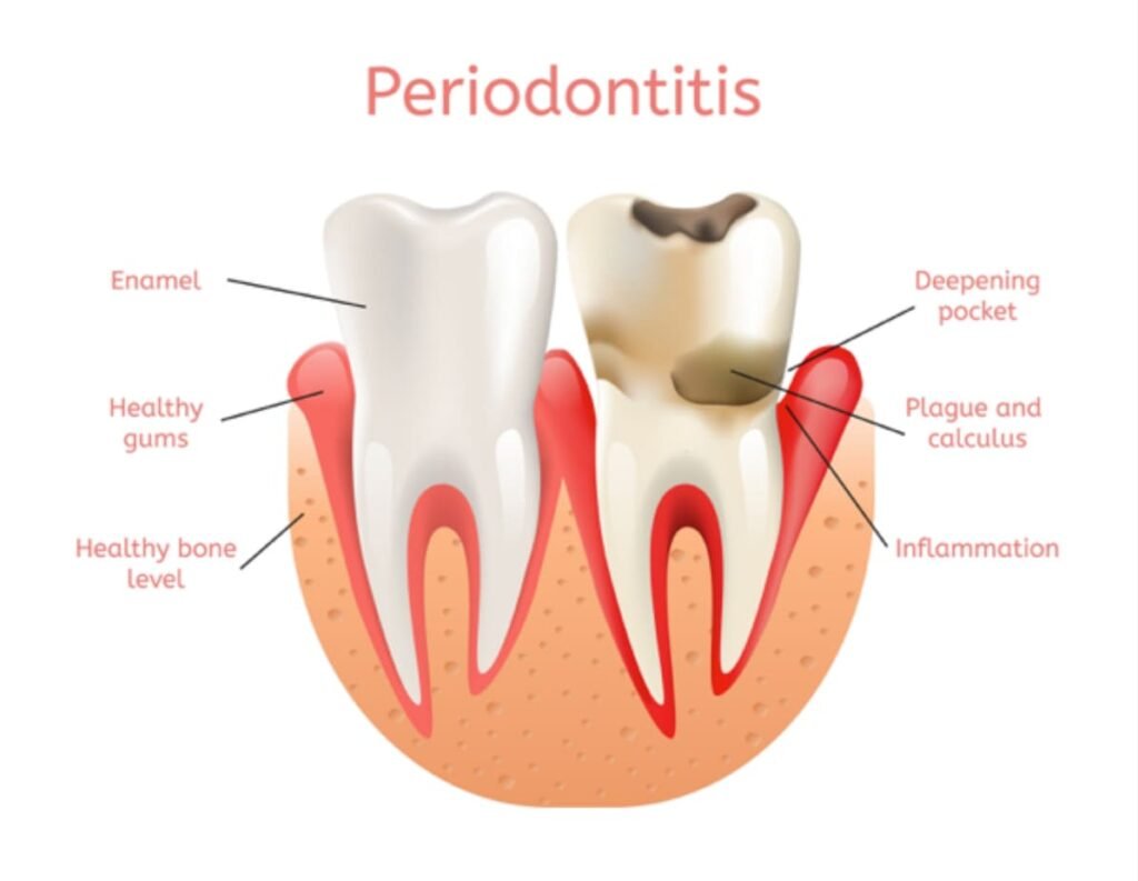 What is Periodontal Maintenance?
