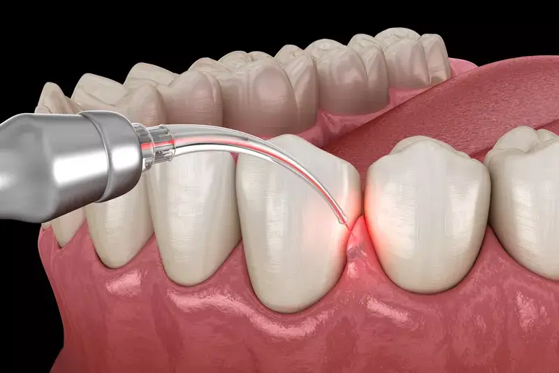 Naturally Heal Receding Gums