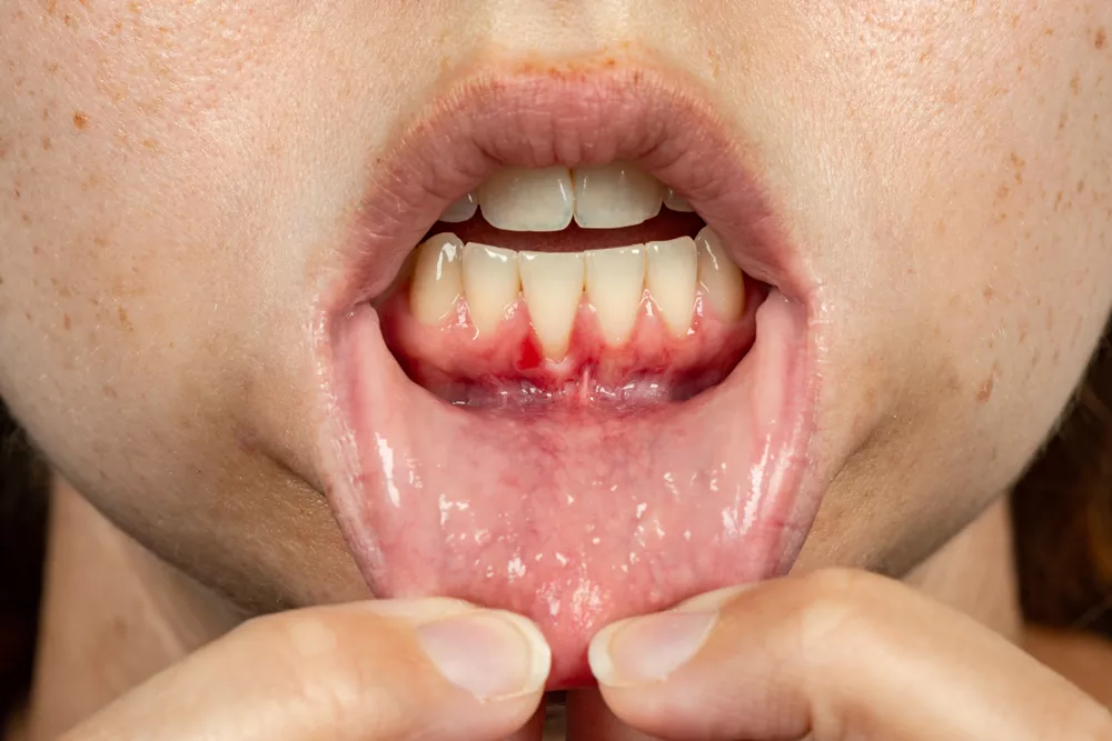 Stimulate Gum Regrowth
