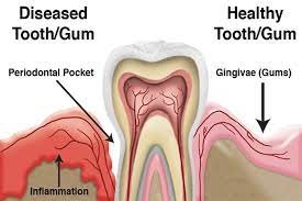 Periodontal Procedures For Gum Line Health