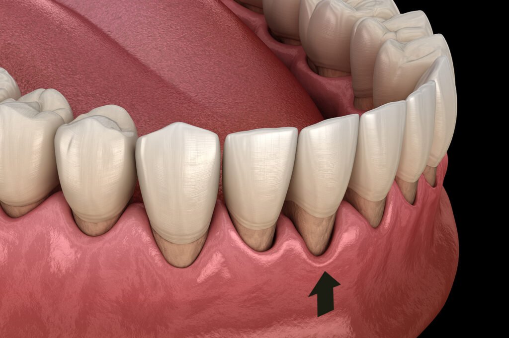surgical gum line treatments