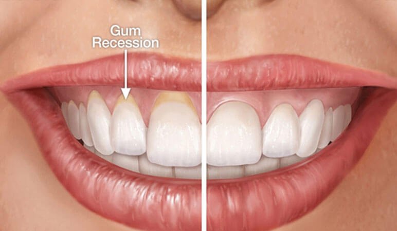 Repairing Gum Recession