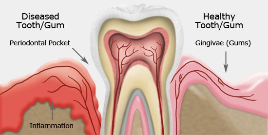How To Heal Receding Gums Naturally