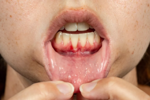 How To Repair Receding Gum Line