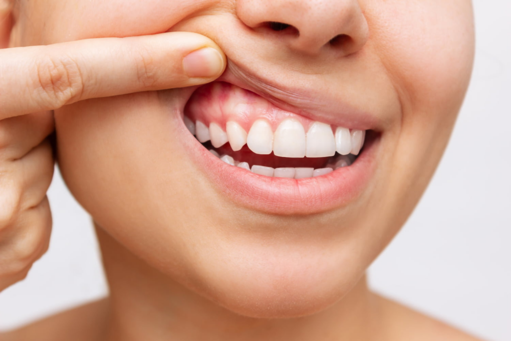 Natures Smile Gum Healing Solution