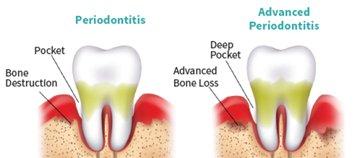 Reverse Receding Gums Natures Smile Gum Healing Solution