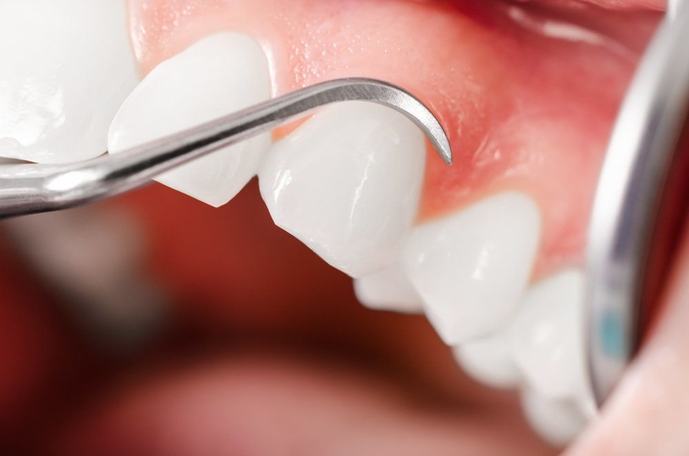 Stimulating Gum Tissue Growth