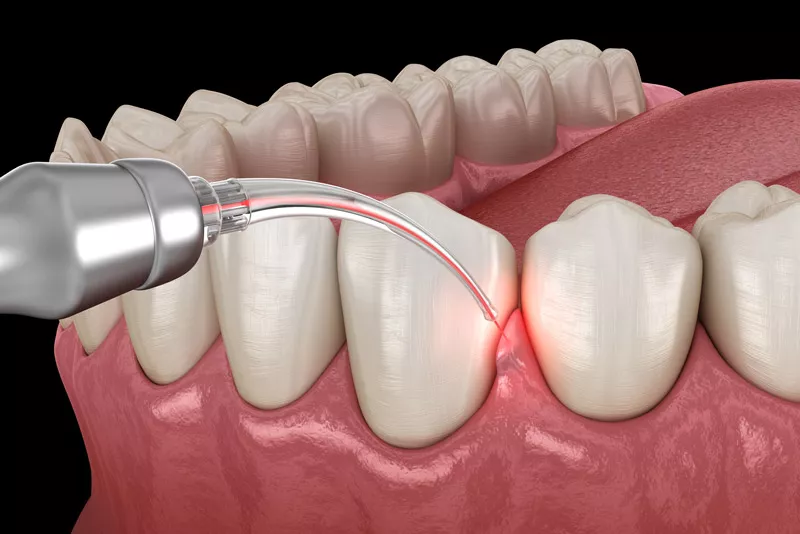 Stimulate Gums Regrowth