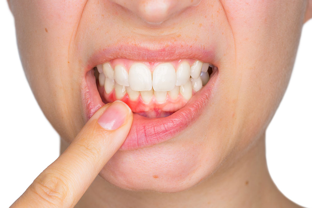Can Receding Gums Heal