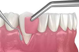 Receding Gums Natural Treatment