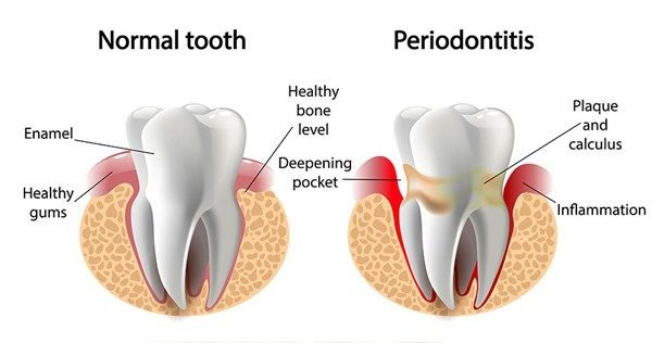importance of gum line health