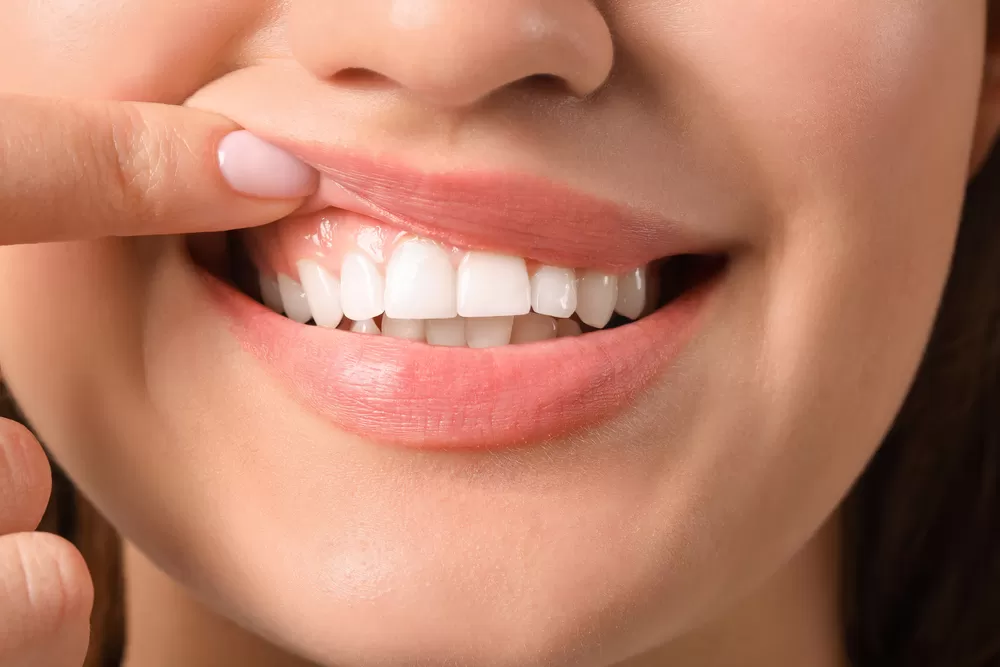 Heal Receding Gums Naturally