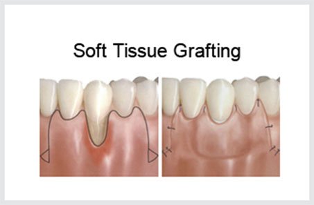 surgical gum line treatments