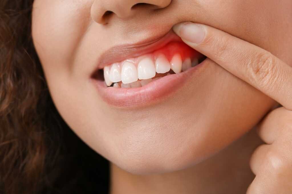 Growing Back Receding Gums
