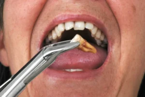 Healing After Wisdom Teeth Removal