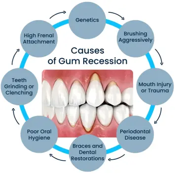What Causes Gum Recession